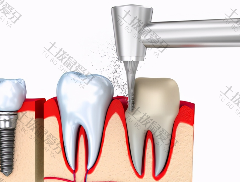 根管治疗过程中牙疼正常吗