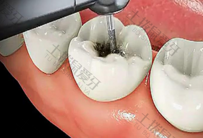 补牙后牙疼是什么原因
