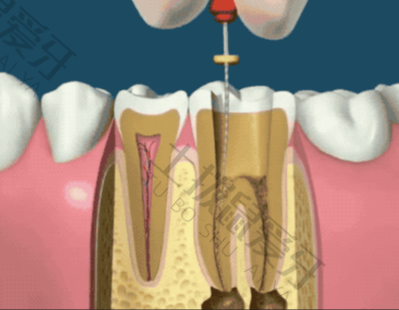 补牙过程分为几个步骤