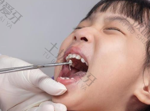 儿童乳牙补牙用什么材料最好