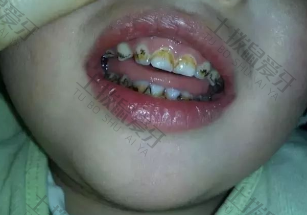 儿童牙齿有洞需要补吗