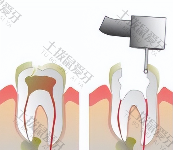 补牙过程分为几个步骤