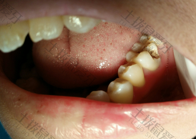 树脂补牙是什么