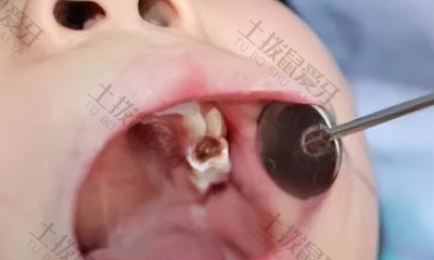 补的牙洞可以维持多久 根管治疗后咬东西疼怎么回事