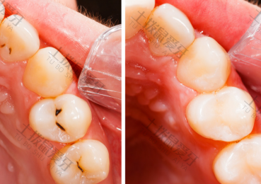 龋齿补牙多少钱一颗 龋齿补牙操作流程