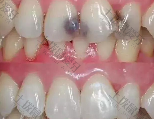 贴面牙齿制作过程