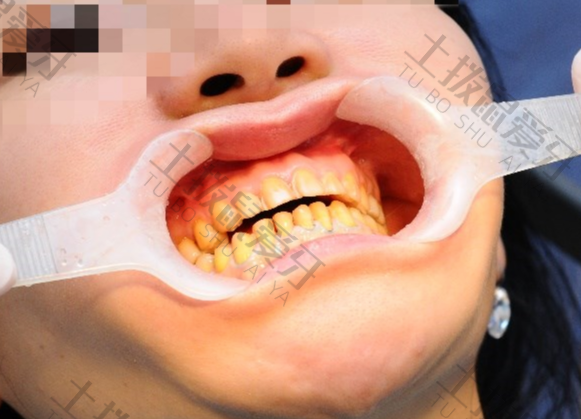 牙齿贴面修复需要磨牙吗