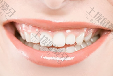 牙齿全瓷贴面需要多久 牙齿贴面价格贵不贵