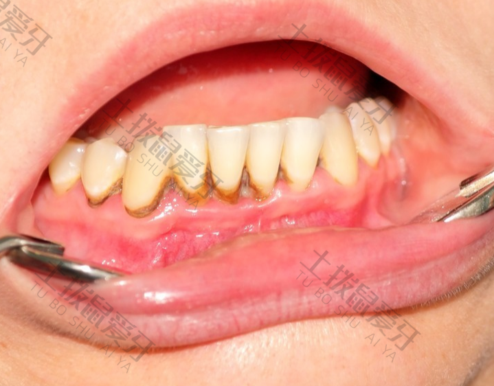 洗牙结石对牙齿有没有伤害