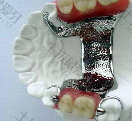 牙齿固定桥修复步骤
