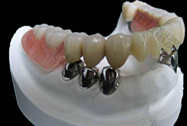 活动牙的制作过程 活动义齿好吗