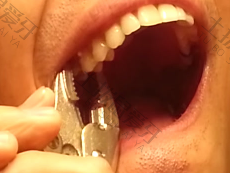 龅牙可以做烤瓷牙修复吗