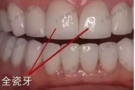 全瓷牙的优缺点