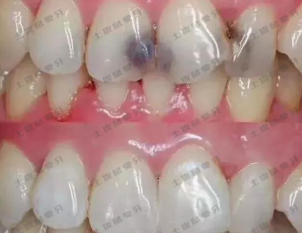 全瓷牙一颗多少钱 全瓷牙能用多久