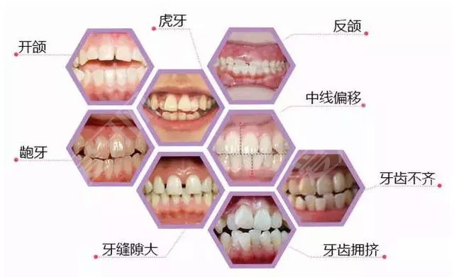 牙齿矫正