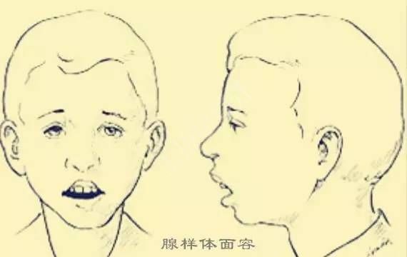 腺样体面容