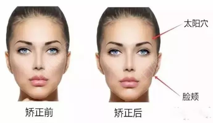 牙套脸