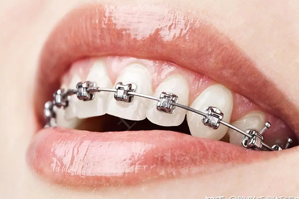 成人牙齿矫正大概要花费多少,牙齿矫正要多久时间