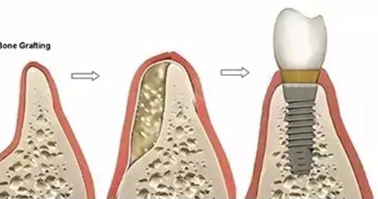 牙齿做种植牙价格多少