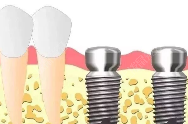 种植牙后牙龈肿痛怎么办