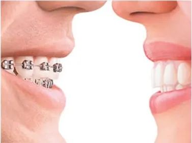 牙齿畸形矫正的最佳时期是什么时候 牙齿畸形矫正的方法