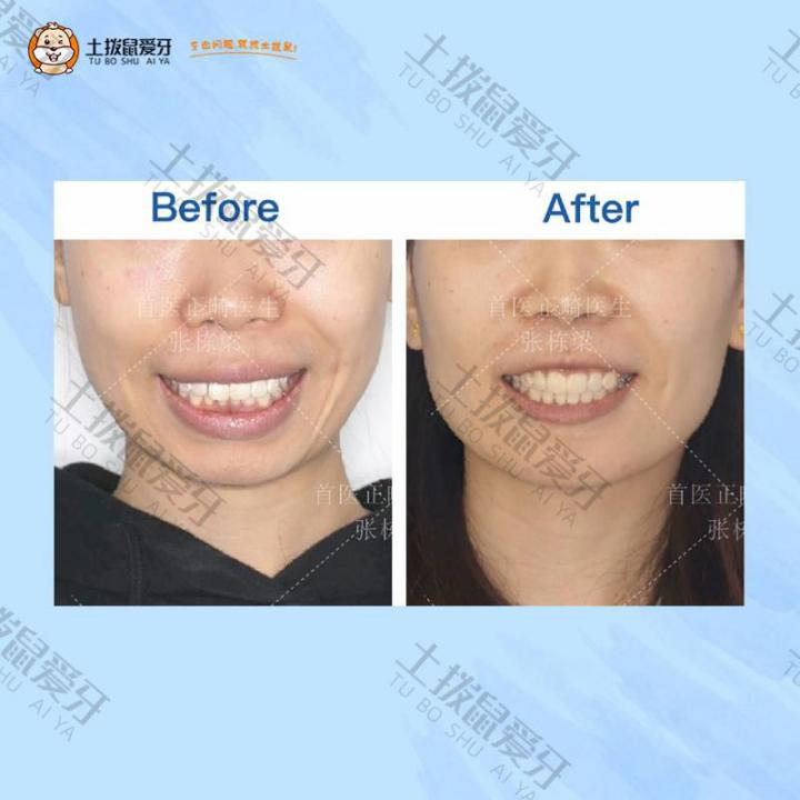骨性前突，深覆合覆盖矫正案例