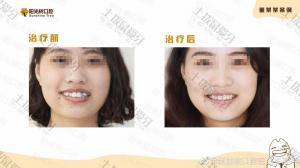 成年女性牙齿不齐虎牙外突矫正案例