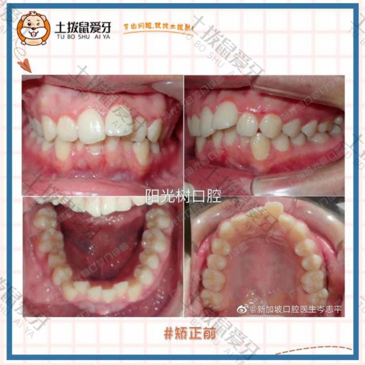 成年人上牙前突牙列不齐矫正案例