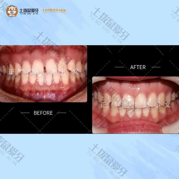 前牙间隙大隐形矫正案例