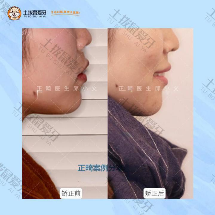 成人双颌前突牙齿矫正案例