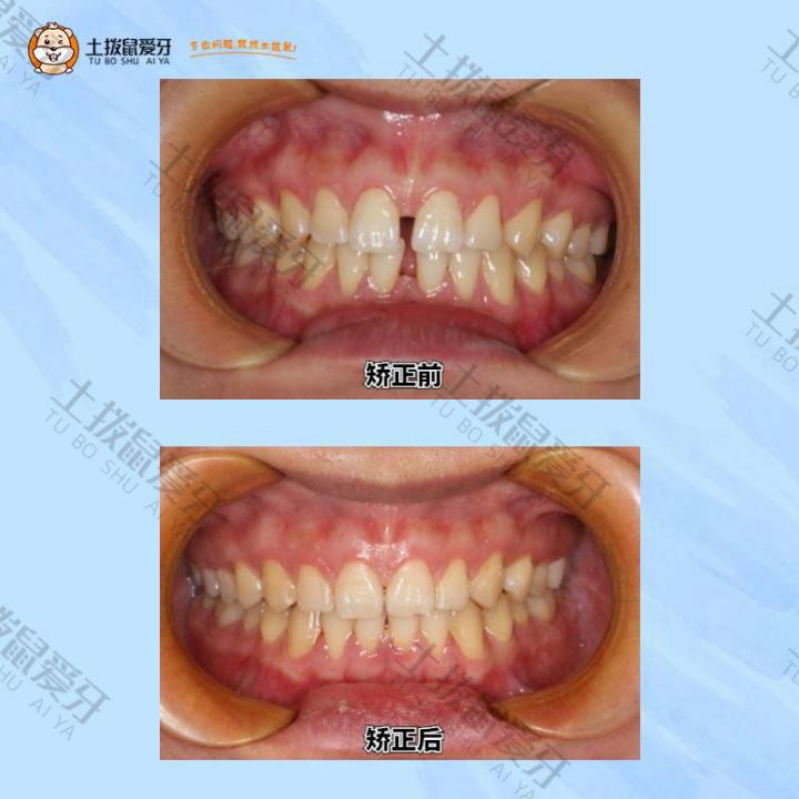 此对比图为开始与中期，因患者怀孕要求暂停矫治