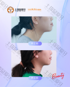治疗前后-侧面90°对比