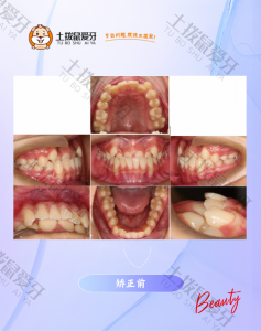 正畸前